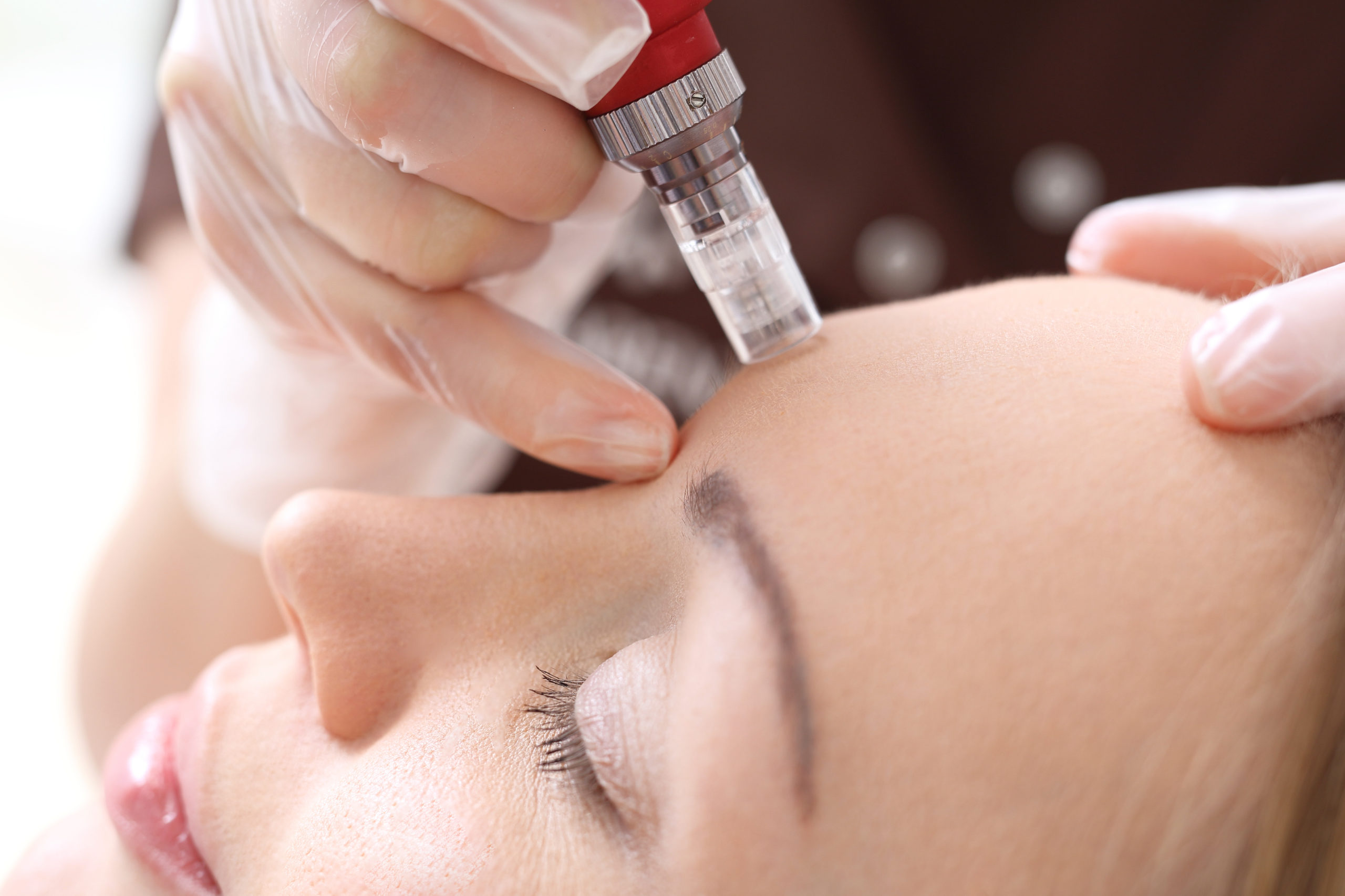Microneedling – V8 Microneedling Natalie Glock Kosmetiksalon